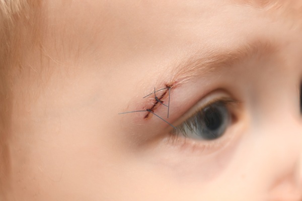 What To Know Ahead Of Suture Removal For Kids